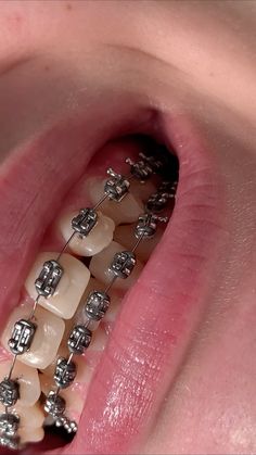 Cute Braces, Teeth Braces, Pretty Jewellery, Braces, Creative Ideas, Collage, Pins, Quick Saves, Color