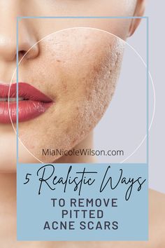 How to get rid of acne scars at home, pitted acne scar removal, how to remove pitted acne scars Acne Scar Diy, Pimple Scars, Acne Scarring