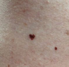 some brown spots on the back of someone's chest