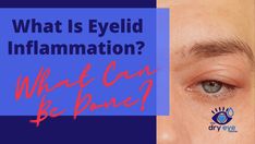 What Is Eyelid Inflammation? What Can Be Done? - Eye Love Dry Eyes, Moving Forward, Click Here, Canning, Health