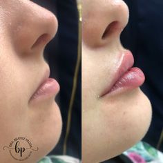 Small Lips With Filler, Lip Filler Examples, Lip Filler Smile Before And After, Lip Filler Inspo 0.5ml, First Time Lip Fillers, Lip Filler Pouty Lips, Natural Lip Filler Inspiration, Lip Filler Half Syringe, Minimal Lip Fillers