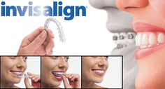 What are the benefits of Invisalign? With Invisalign, adults who want to maintain their mature images don’t have to deal with the embarrassment of metal braces. Another obvious advantage of Invisalign is that the aligners are removable, so patients can take them out to eat, brush, and floss. ‪#‎invisalign‬ ‪#‎braces‬ ‪#‎clearbraces‬ ‪#‎dentist‬ Straighten Teeth Without Braces, Invisalign Braces, Oral Surgeon, Natural Teeth