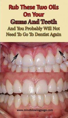 10 easy ways to treat receding gums naturally! #FitLife #FitnessTips #HealthyLiving #SelfCare #NutritionTips #HealthTips #HealthyLifestyle #Wellness Teeth Hacks, Toothache Relief, Dental Tips, Dental Cavities, Ham Salad