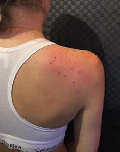 a woman with acne on her back