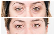 Eye Bag Surgery, Tear Trough Filler, Eye Bag Removal, Remove Eye Bags, Droopy Eyes, Eyelid Lift, Botox Injections