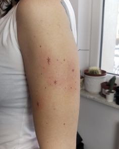 a woman with acne on her arm standing in front of a kitchen counter top