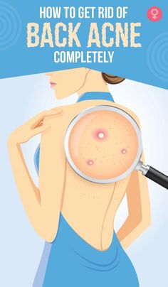 Back acne is a common skin condition that can cause pain and embarrassment. Fortunately, you can use simple home remedies to treat it and tips to prevent it. Get Rid Of Back Acne, Rid Of Back Acne, Back Acne Remedies, Chest Acne, Back Acne, Forehead Acne, Bad Acne, Acne Overnight, Natural Acne Remedies