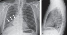 an x - ray shows the chest and ribs