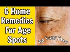 6 Home Remedies For Age Spots on The Face Age Spots On Face, Spots On Face, Diy Remedies, Age Spots, Clogged Pores, Hormone Imbalance, Skin Issues, Spot On, Blackheads