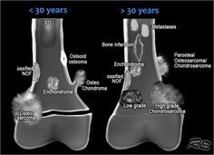 an x - ray shows the different stages of osteoporoma and endoscopy