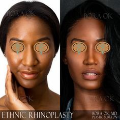 👨🏽‍⚕👉🏼 : Closed approach to Ethnic Rhinoplasty. Our techniques tailored to the patients who desire nasal refinement while preserving their cultural identity. For patients of African, Asian, Middle Eastern and all other ethnic descents, the goal is improving their appearance without diminishing their ethnicity. 📱 Schedule a Whatsapp Consultation: UK +44 7557 501699 TR +90 532 711 60 82 📱 Schedule a Skype Consultation : drboraok 📧 : dr@drboraok.com 🌍 : www.drboraok.com Nose Types, Pretty Nose, Wide Nose, Perfect Nose, Nose Shapes