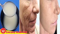 Face Wrinkles Remedies, Wrinkles Remedies Face, Mouth Wrinkles, Wrinkle Remedies, Wrinkle Free Skin, Neck Wrinkles, Skin Care Wrinkles, Face Wrinkles, Saggy Skin