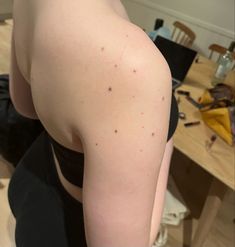 the back of a woman's shoulder with acne on it, in front of a dining room table