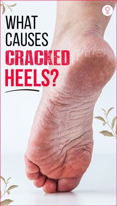 What Causes Cracked Heels? Apart from all these acclaims, there are so many advertisements which boast about beautiful feet. However, having heels in the perfect condition is a time-consuming task. Regular work and busy schedules may put you off from taking break and concentrating on your feet. #crackedheels #skincare #skincaretips Dry Heel Remedies, What Causes Cracked Heels, Cracked Heels Diy, Homemade Foot Cream, Heal Cracked Heels