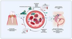 Obese Pregnancy, Systemic Inflammation, Immune Cells, Insulin Resistance, Art