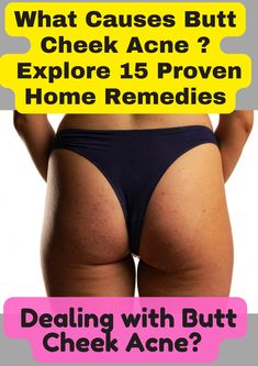 Find out what causes butt cheek acne and explore 15 proven home remedies to treat and prevent it for smoother, healthier skin.
#ButtCheekAcne
#AcneSolutions
#HomeRemedies
#ClearSkin
#SkinCareTips
#BeautyHacks
#HealthySkin
#AcneHelp
#PimpleTreatment
#NaturalRemedies
#SkinCareRoutine
#DIYSkincare
#BodyAcne
#SkinHealth
#SelfCare Cheek Acne Cause, Acne Causes, Treat Acne, Body Acne