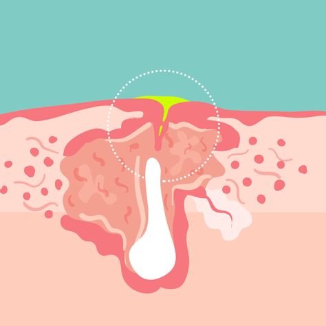 This Is What's Really Coming Out When You Pop Your Pimples+#refinery29 Pimple Solution, Pimples On Forehead, Blind Pimple, Pimples Under The Skin, Acne Help, Face Care Routine, Types Of Acne, Diagram Design, Facial Skin Care Routine