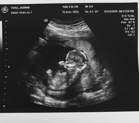 Hasil Usg Kandungan, 10 Week Ultrasound Pictures, 10 Weeks Pregnant Ultrasound, 9 Weeks Pregnant Ultrasound, Boy Ultrasound Pictures, Hasil Usg, Baby Gender Ultrasound, Boy Ultrasound, 12 Week Ultrasound