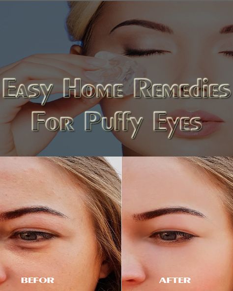 The most asked question is how can you get rid of puffy eyes in the morning? So, I'd like to tell you something special to get rid of puffy eyes, yes I'm going to tell you the top best home remedies and diet for Puffy eyes. How To Get Rid Of Puffy Eyes In Morning, Puffy Eyes Remedy How To Get Rid, How To Get Rid Of Puffy Eyes, Puffy Under Eyes, Puffy Eyes Remedy, 6 Hours Of Sleep, Remove Dark Circles, Dark Circles Under Eyes, Beauty Tips For Face