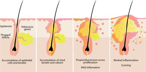 cystic-back-acne-pict-cystic-acne-diagram-medical-anatomy-… | Flickr Remedies For Pimples, Overnight Acne Remedies, Blind Pimple, Pimples Under The Skin, Pimples Remedies, Acne Vulgaris, Acne Causes, Acne Solutions, Cystic Acne