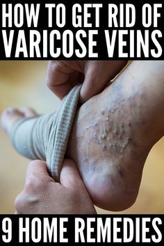 Vericous Veins, Varicose Veins Essential Oils, Home Remedies For Spiders, Varicose Veins Causes, Varicose Vein Remedy, Leg Veins, Venous Insufficiency, Natural Home Remedies, Natural Treatments