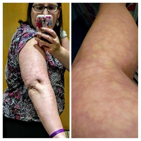 livedo reticularis rash on woman's arm Leg Discoloration, Groin Rash, Skin Rashes Pictures, Livedo Reticularis, Rash On Hands, Leg Rash, Ugly Legs, Red Blotchy Skin, Fungal Rash