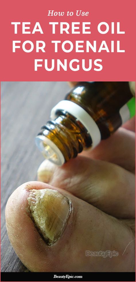 Nail Fungal Infection Toenails, Toe Nail Fungal Infection, Medical Remedies, Toenail Fungal Infection, Tea Tree Oil Uses, Nail Remedies, Natural Antifungal, Toenail Fungus Remedies, Nail Fungus Remedy