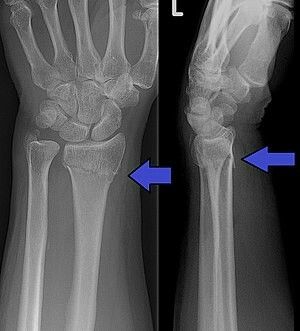 Colles Fracture, Radius Bone, Open Fracture, Types Of Fractures, How To Style Hair, Fracture Healing, Median Nerve, Ct Scan, Medical Studies