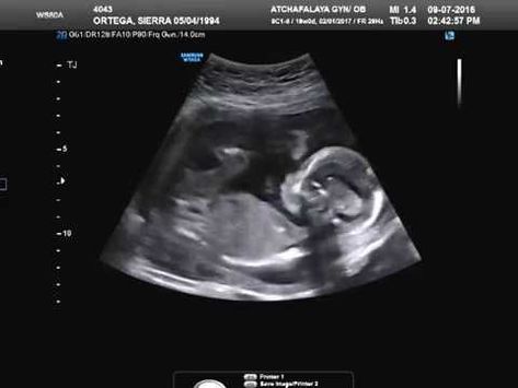 baby girl ! 19 Weeks Pregnant Ultrasound, 20 Week Ultrasound Pictures, 20 Weeks Pregnant Ultrasound, 12 Week Ultrasound Pictures, 13 Weeks Pregnant Ultrasound, 11 Weeks Pregnant Ultrasound, 17 Weeks Pregnant Ultrasound, 12 Week Ultrasound Gender, Ultrasound Boy Or Girl