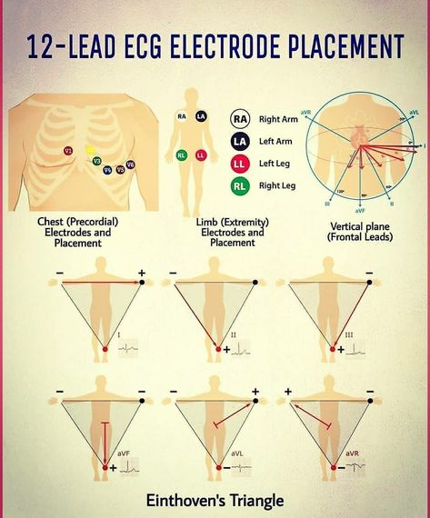 12 - lead ECG Electrode Placement Ekg Lead Placement Cheat Sheets, 12 Lead Ekg Cheat Sheet, Ecg Lead Placement, Ekg Placement 12 Lead, 12 Lead Ekg Placement, Ekg Placement, Lead Placement, Medic School, Ekg Leads