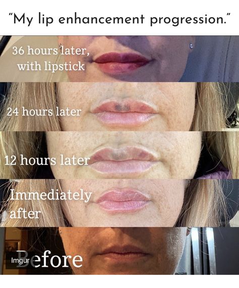 Juvederm Lips, Injectables Fillers, Lip Filler, Lip Serum, Lip Enhancement, Diy Lips, Choppy Hair, Lip Injections, Perfect Lips