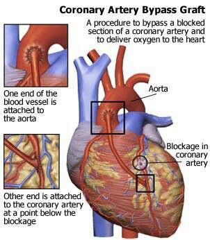 CABG-- excellent visual Nursing Cardiac, Medical Coding Humor, Nursing Knowledge, Cardiothoracic Surgery, Medical Illustrations, Cardiac Nurse, Nursing Assessment, Coronary Artery, Pressure Headache