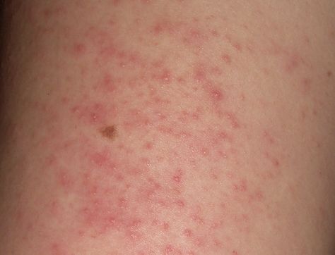 Skin Rashes Pictures, Skin Rash Remedies, Rash On Hands, Body Rash, Itchy Skin Rash, Rash On Face, Rashes Remedies, Itchy Rash, Heat Rash