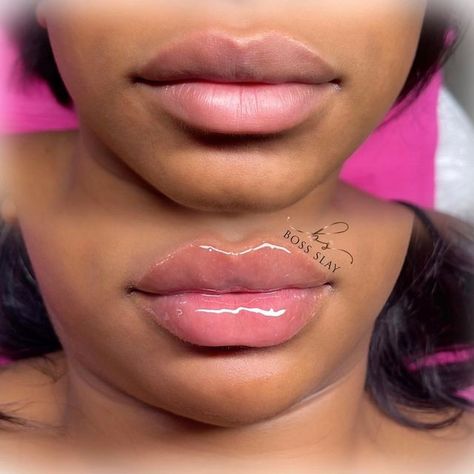 Cute Lip Fillers, Lip Filler Shape Ideas Black Women, Lip Fillers On Black Women, Bratz Doll Lip Filler, Lip Filler Before And After Black Women, Lip Injections Before And After 1ml, Lip Injections Aesthetic, 1ml Lip Filler Before And After, Lip Filler Black Women