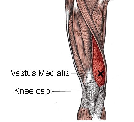 diagram showcsing the vastus medialis and how it protects the knee cap and stabilizes the knee joint Vastus Medialis Exercises, Vmo Exercises, Stretches For Dancers, Vastus Medialis, Ball Squats, Acl Rehab, Knee Rehab, Knee Health, How To Strengthen Knees