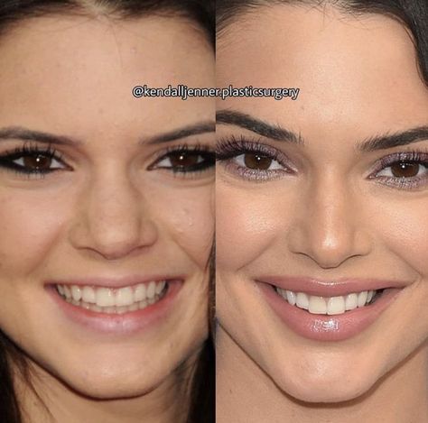 Kendall Jenner Before Surgeries, Kendall Jenner Plastic Surgeries, Kendall Jenner Before And After Surgery, Nose Plastic Surgery Before After, Celebrity Plastic Surgery Before After, Alarplasty Before After, Kendall Jenner Surgery, Blephoraplasty Before And After, Plastic Surgery Before And After