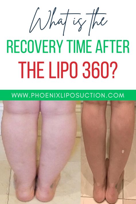 Image by- About Infini Phoenix Liposuction

#liposuction #plasticsurgery #lipo #tummytuck #bbl #cosmeticsurgery #breastaugmentation #plasticsurgeon #mommymakeover #beauty #bodycontouring #rhinoplasty Lipo 360 Before And After Black Women, Vaser Lipo Before And After, Lipo 360 Before And After, Lipo 360, Vaser Lipo, Lipo Before And After, Fat Transfer, Laser Surgery, Mommy Makeover