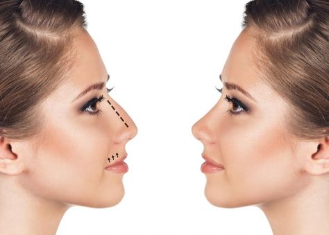 For reshaping the nose you could do without any cut or stitches with the new sensational non surgical rhinoplasty. Understand what it is? Nose Fillers, Face Yoga Method, Rhinoplasty Nose Jobs, Nose Reshaping, Rhinoplasty Surgery, Straight Nose, Perfect Nose, Nose Surgery, Nose Shapes