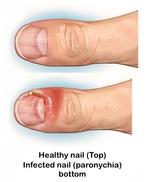 🚨Paronychia is an infection of the skin around the nails, typically affecting the fingers or toes. It can be acute or chronic: 1️⃣ Acute Paronychia: This is usually caused by bacteria, such as Staphylococcus aureus, entering through a break in the skin, often from a hangnail or nail biting. Symptoms include redness, swelling, pain, and sometimes pus formation around the nail. 2️⃣ Chronic Paronychia: This often results from repeated exposure to moisture, leading to irritation and infection... Hang Nail Remedy Infected Finger, Infected Cuticle, Nails School, Nail Remedies, Antifungal Cream, Nail Infection, Medical Tests, Diy Remedies, Nail Biting