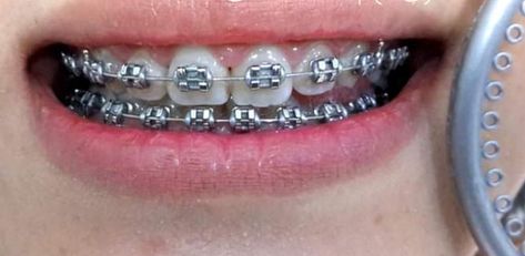 Perfect Teeth Braces, Braces Colours, White Braces, Silver Braces, Short Hair Glasses, Pretty Teeth, Braces Tips, Getting Braces, Cute Braces