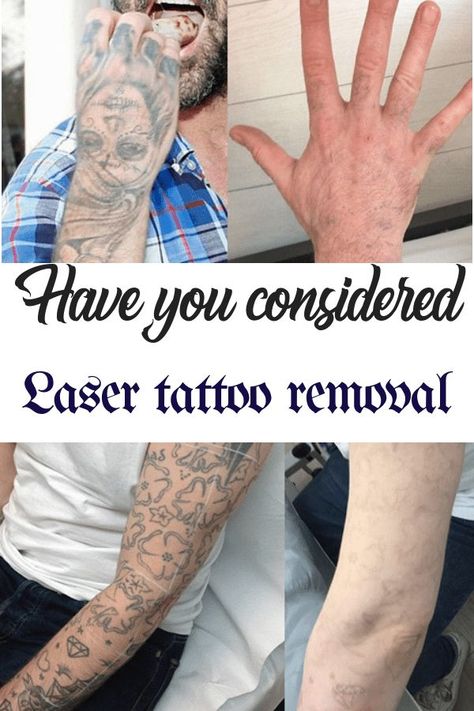 Picosure Tattoo Removal, Tattoo Fixers, Ayurveda Hair, Tattoo Cream, Laser Removal, Uk Lifestyle, Tattoo Care, Tattoo Equipment, Tattoo Aftercare