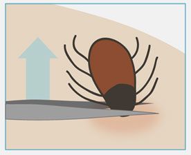 Removing a Tick Embedded in Skin camping safety tips Removing A Tick From A Person, Camping Safety, Safety Tips, Ticks, Skin