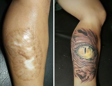 10+ Amazing Tattoos That Turn Scars Into Works Of Art Surgical Scar Tattoo, Pacman Tattoo, Medical Tattoos, Fish Bone Tattoo, Scars Tattoo, Stretch Mark Tattoo, Tattoo Over Scar, Scar Cover Up, Medical Tattoo