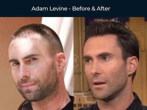 Adam Levine - Hair Transplant Before & After Before And After Hair Transplant, Hair Transplant Before And After, Adam Levine Hair, Adam Levine Haircut, Hairline Transplant, Taper Haircut Men, Men Hairline, Adam Levine Style, Buzz Cut For Men