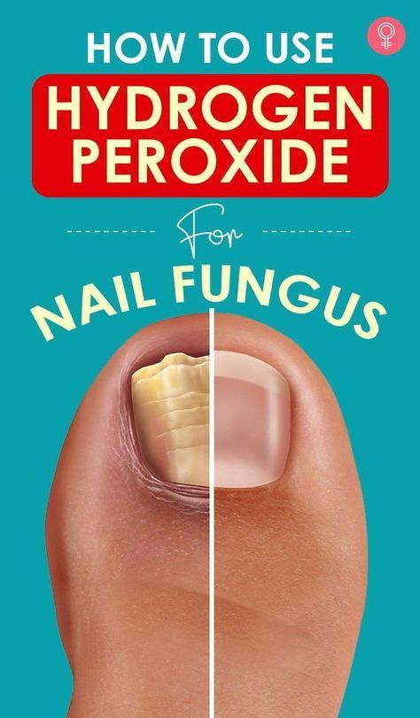 Fungal Infection Remedies, Toenail Health, Toenail Fungal Infection, Nail Remedies, Peroxide Uses, Toenail Fungus Remedies, Nail Fungus Remedy, Nail Infection, Fungal Nail