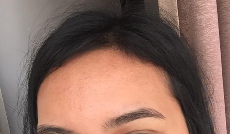 What are these itchy acne-like bumps on my forehead? How can i get rid of them? [Routine help] Clear Forehead, Round Forehead, Flat Forehead, Small Forehead, Fungal Acne, Classy Photography, Small Flat, How Do I Get, I Wish I Had