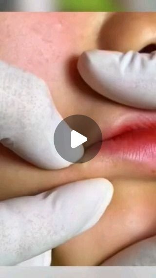 Spot Popping Videos, Lip Blackheads, Leg Pimples, Cysts Popping Videos, Pimple Poppìng Videos Satisfying, Blackheads Removal Satisfying Videos, Boil Popping Videos, Blackheads Popping Videos Nose, Pimple Poppìng Videos