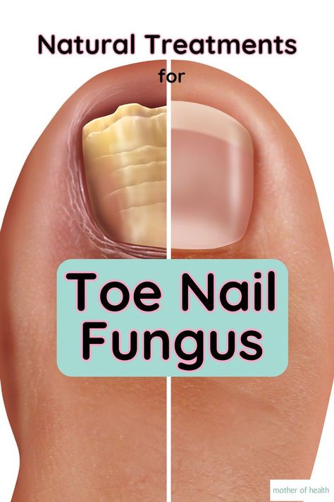 anti fungal nail Antifungal Essential Oil, Nail Remedies, Natural Antifungal, Toenail Fungus Remedies, Natural Face Cleanser, Nail Fungus Remedy, Fungal Nail, Ayurvedic Remedies, Nail Care Routine