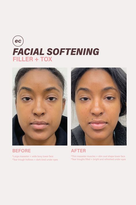 Facial Softening With Filler + Botox | Esthetics Center | If you want your esthetic treatments to look undetectable, multiple areas need to be treated. 👉Botox can help relax the masseter muscles, reducing their size and creating a slim oval shape for the lower face. 👉Dermal filler can help restore lost volume and brighten the under-eye area. To book - 📱Visit: www.estheticscenter.com 📞Call: 916.941.9400 Face Dermal, Botox Before And After, Tear Trough, Tears In Eyes, Dermal Fillers, Eye Area, Real People, Oval Shape, Muscles