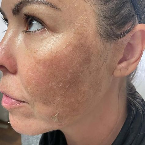 My Skin Looks Worse After Chemical Peel - Is That Normal? Facial Chemical Peel Before And After, Chemical Peel Before And After Black, Chemical Peel Before And After, Botox Business, Chemical Face Peel, Vi Peel, Skincare Marketing, Peeling Face, Burn Remedy